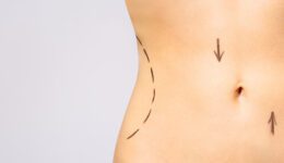 O que é Abdominoplastia?