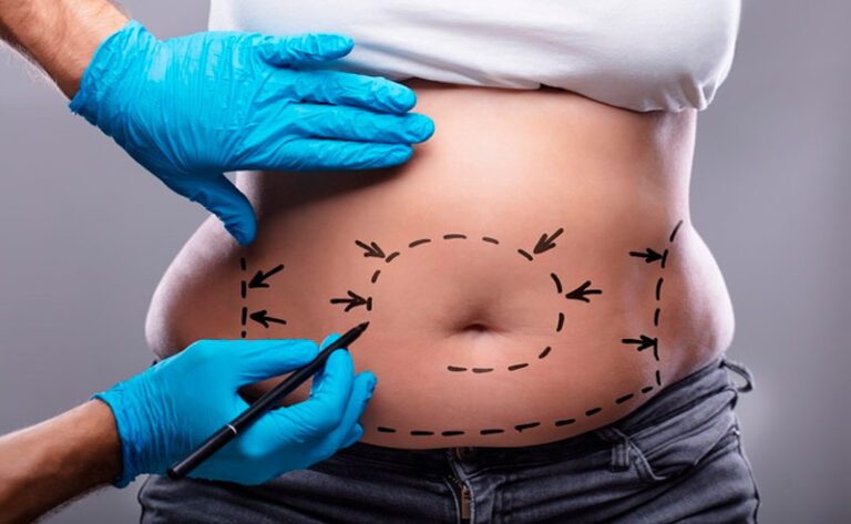 Leia mais sobre o artigo Lipoescultura: o que é, como é feita e recuperação