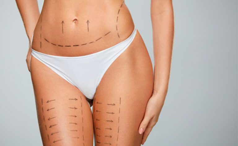 Leia mais sobre o artigo Cirurgia plástica pós-bariátrica: saiba quando fazer e quais são as recomendações médicas